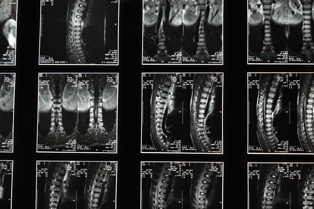 spinal fusion settlement