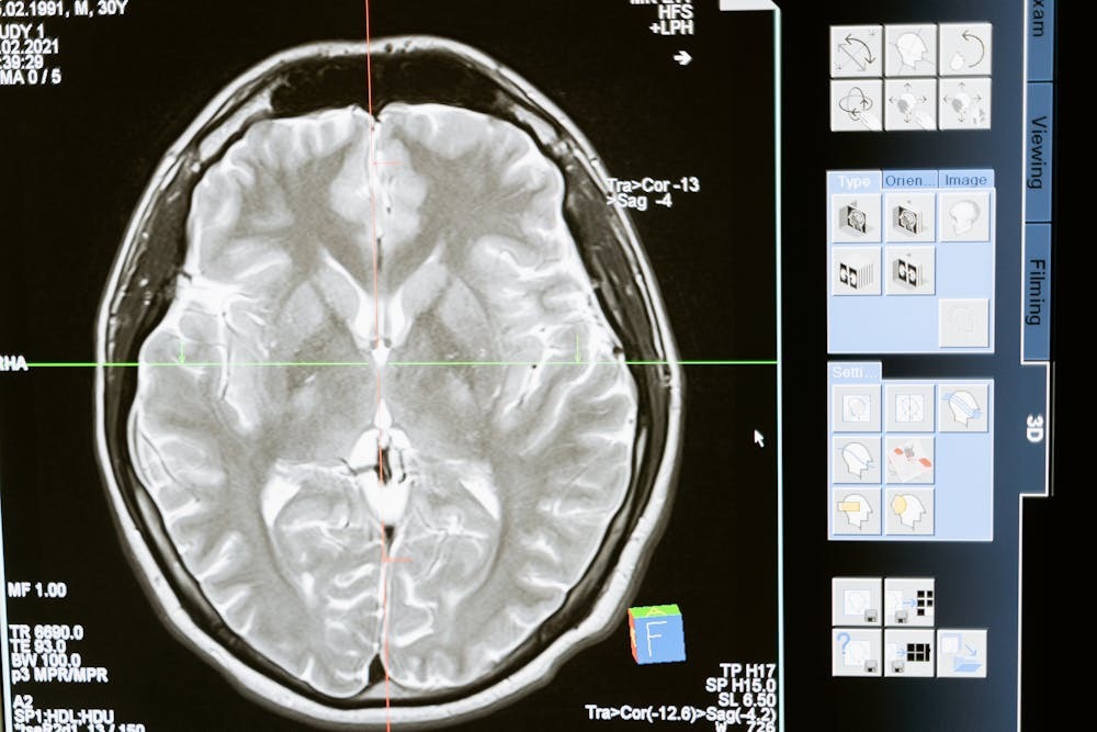 post-concussion syndrome settlement value