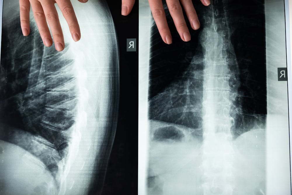 incomplete spinal cord injury